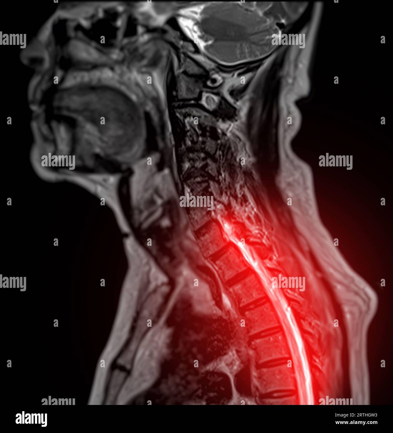 MRT der C-Wirbelsäule oder Magnetresonanzbild der sagittalen T2 FS-Ansicht der Halswirbelsäule zur Diagnose der Spondylose, die die zervikale spondylotische Myelopathie A verursacht Stockfoto