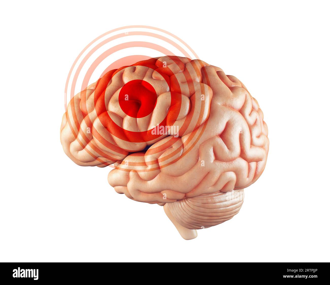 Krankheit oder Schmerzkonzept des menschlichen Gehirns isoliert auf weiß mit rotem Schmerzzeichen darauf. 3D-Abbildung Stockfoto