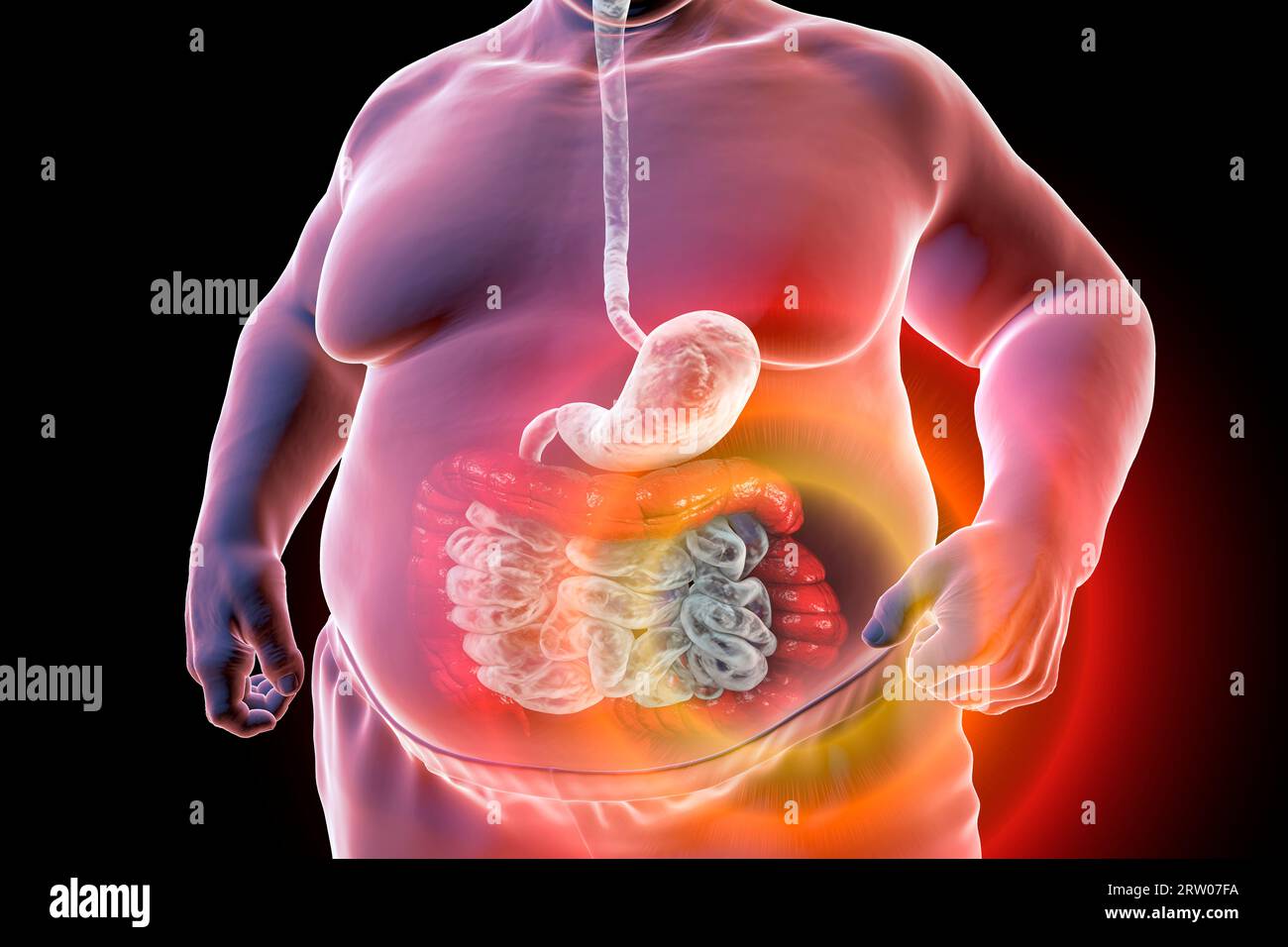 Reizdarmsyndrom, Illustration Stockfoto