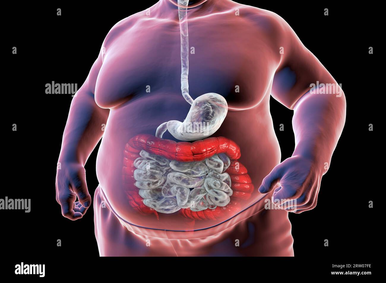 Reizdarmsyndrom, Illustration Stockfoto