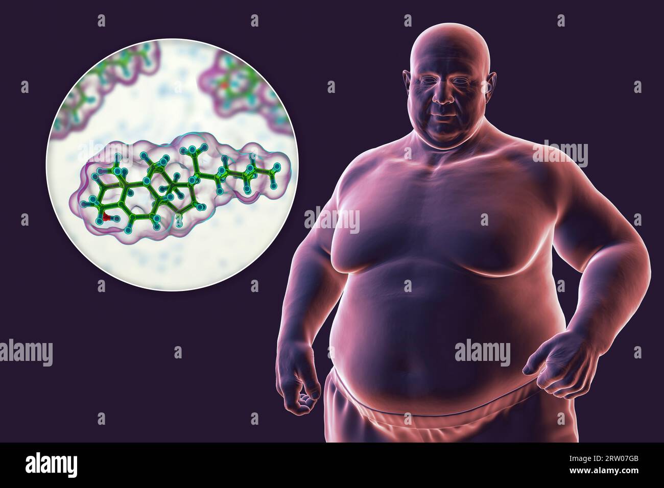 Übergewichtiger Mensch und Cholesterinmolekül, Illustration Stockfoto