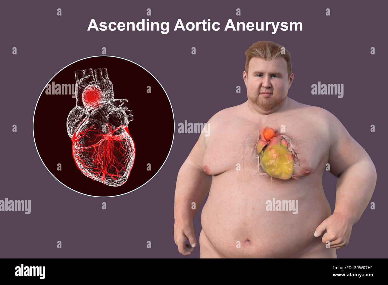 Adipöser Mann mit Aortenaneurysma ascendens, Illustration Stockfoto