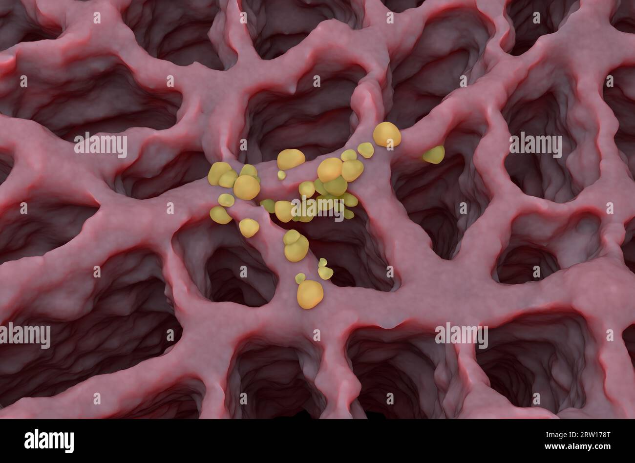 Kleine Krebstumoren im Lungengewebe: Lungenkrebs (LC) - isometrische Betrachtung 3. Illustration Stockfoto