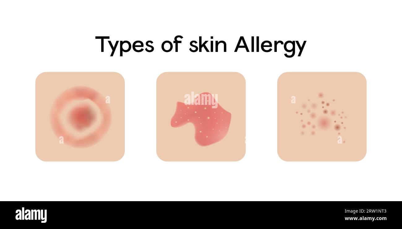 Arten von Hautallergie-Vektor-Illustration Stock Vektor