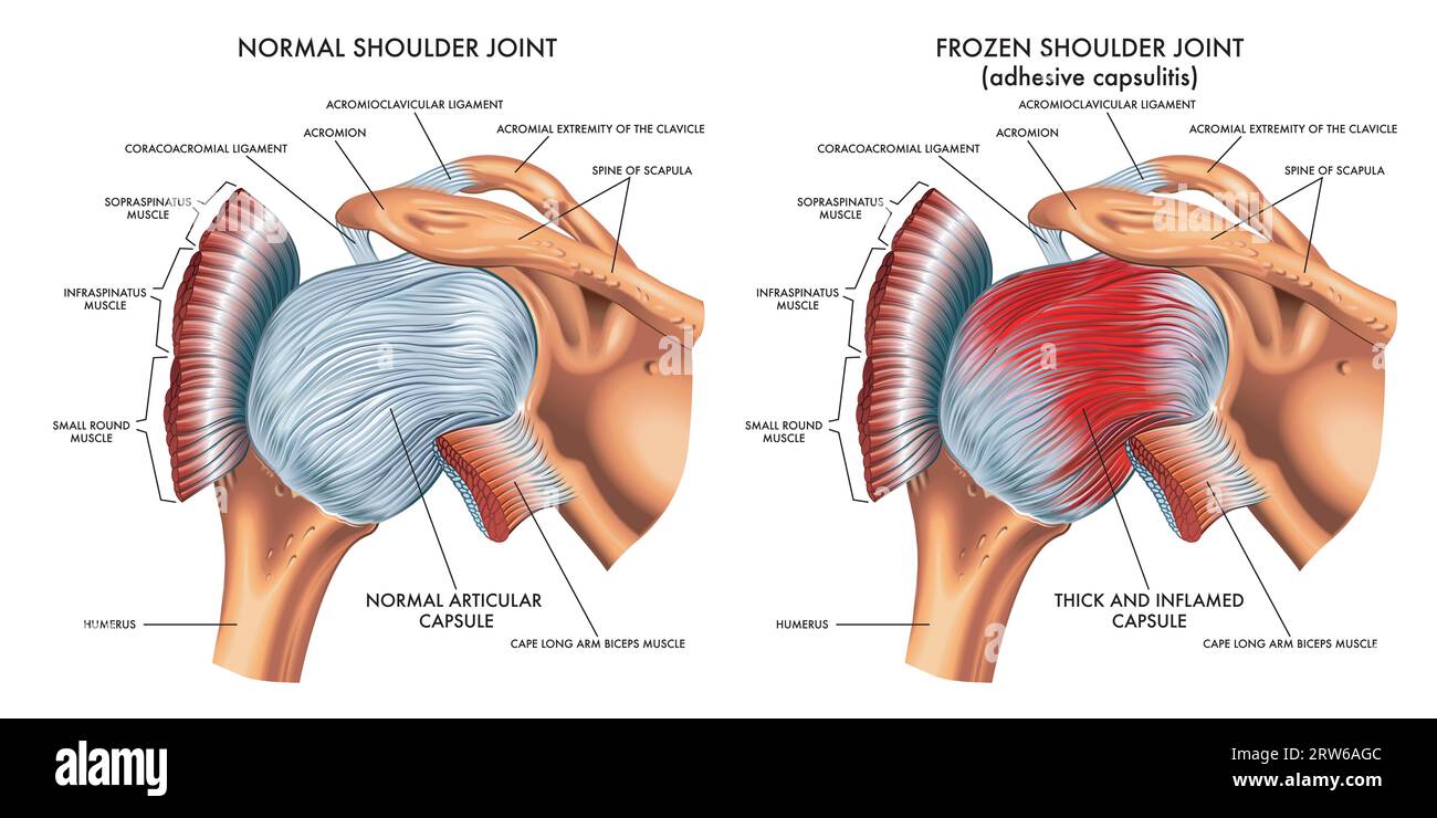 Medizinische Illustration zeigt den Unterschied zwischen einem normalen Schultergelenk und einem gefrorenen Schultergelenk, mit Anmerkungen. Stockfoto