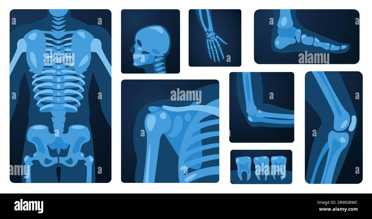 Röntgenkörperteile. Menschliches Skelett Kniearm Brustgelenkfuss, medizinisches Röntgenbild-Konzept der Knochenverletzung. Vector Flat Set Stock Vektor
