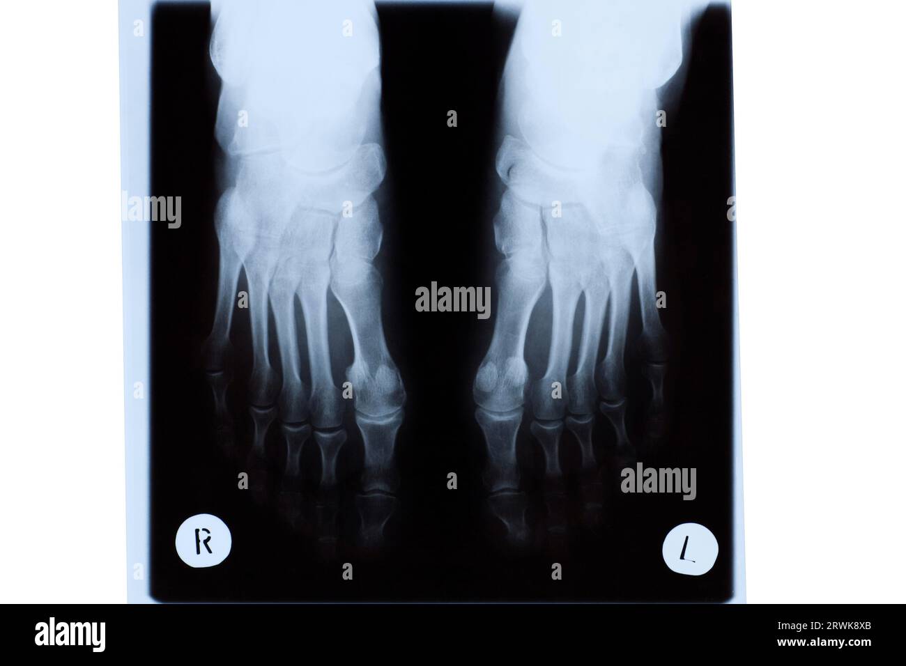 Röntgenaufnahme reifer Frauenfüße Stockfoto