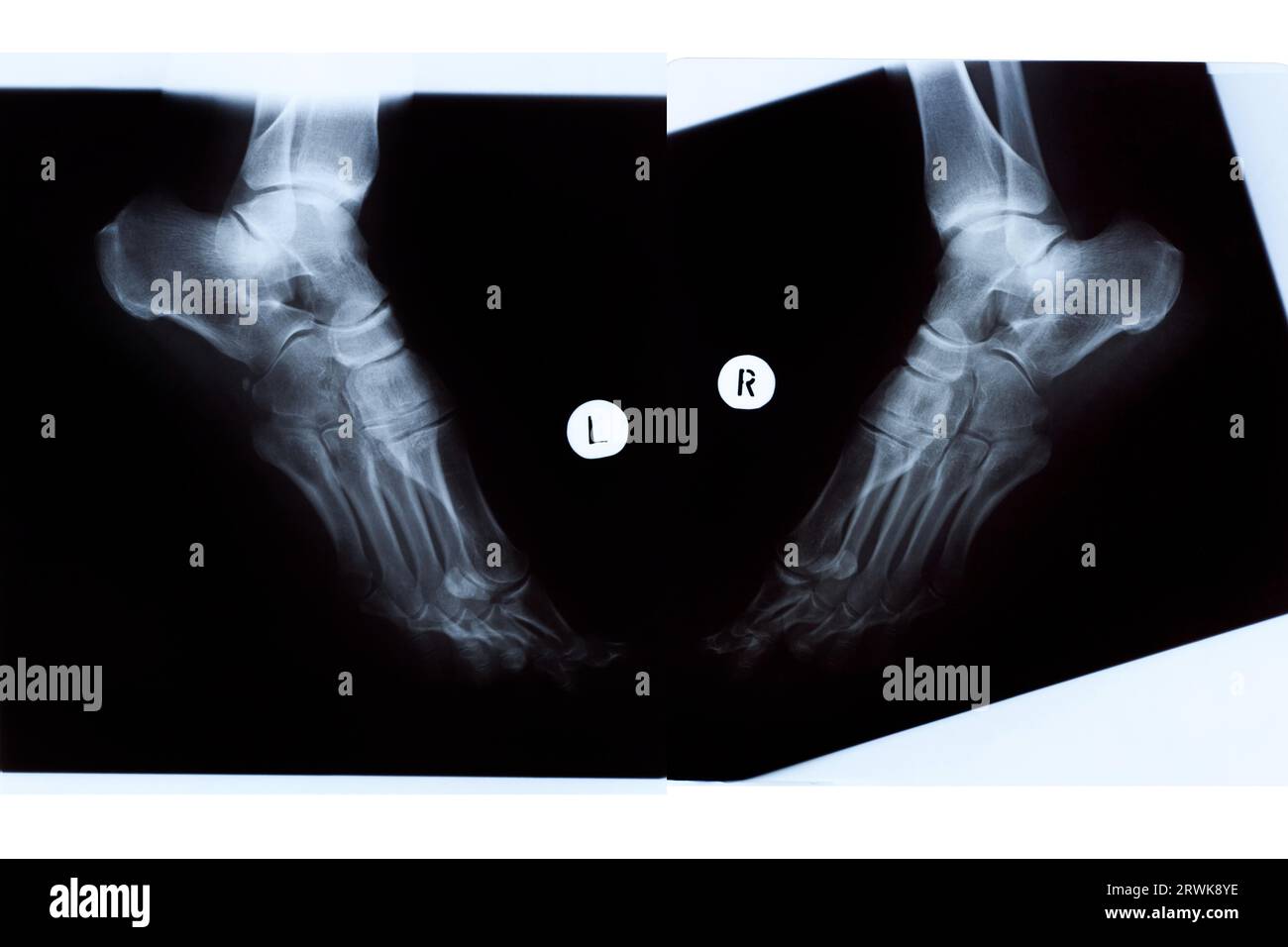 Röntgenaufnahme der Reifen Frauenfüße, linke und rechte Seitenansicht Stockfoto