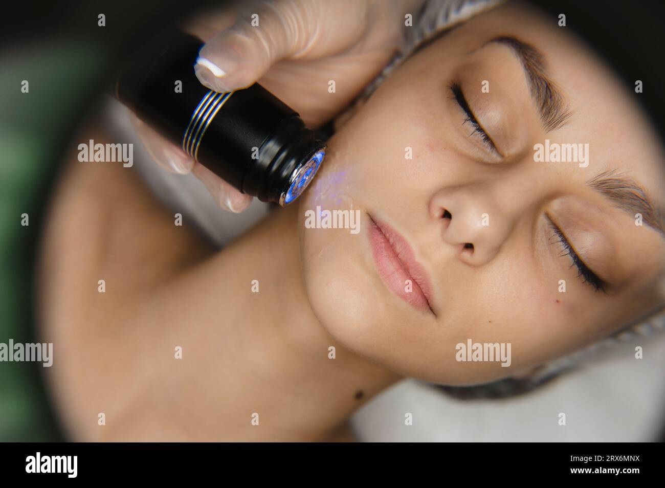 Hand eines Dermatologen, der ein RF-Lifting-Verfahren an der Frau durchführt Stockfoto