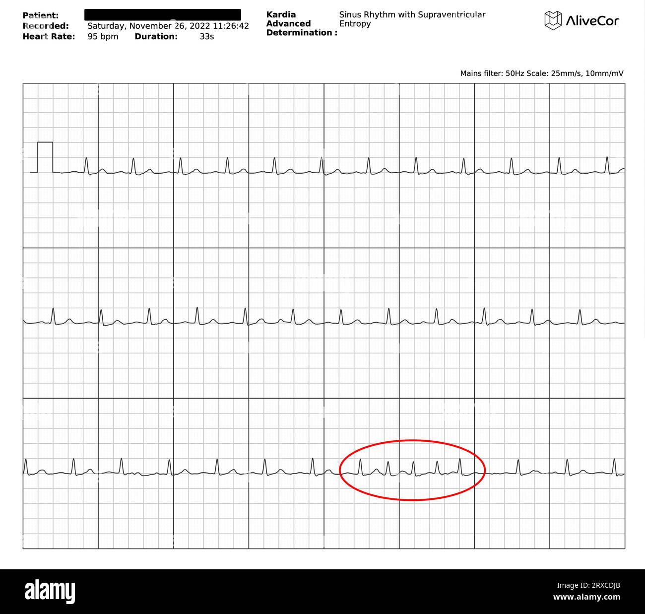 EKG/EKG-Diagramm/Diagramm/Kurve mit normalem Sinusrhythmus (NSR) mit einem Burst supraventrikulärer Ektopie (SVE)/vorzeitiger Vorhofkontraktionen (PACS) Stockfoto