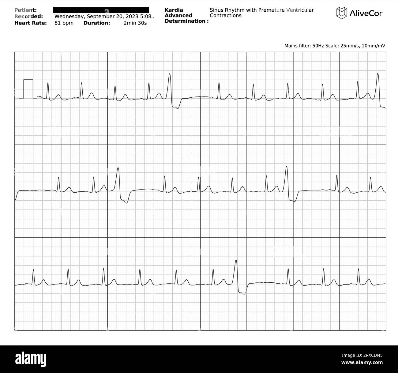 EKG/EKG-Diagramm/Diagramm/Diagramm/Kurve mit einigen vorzeitigen ventrikulären Kontraktionen (VES), auch bekannt als ventrikuläre ektopische Schläge/Extrasystolen Stockfoto