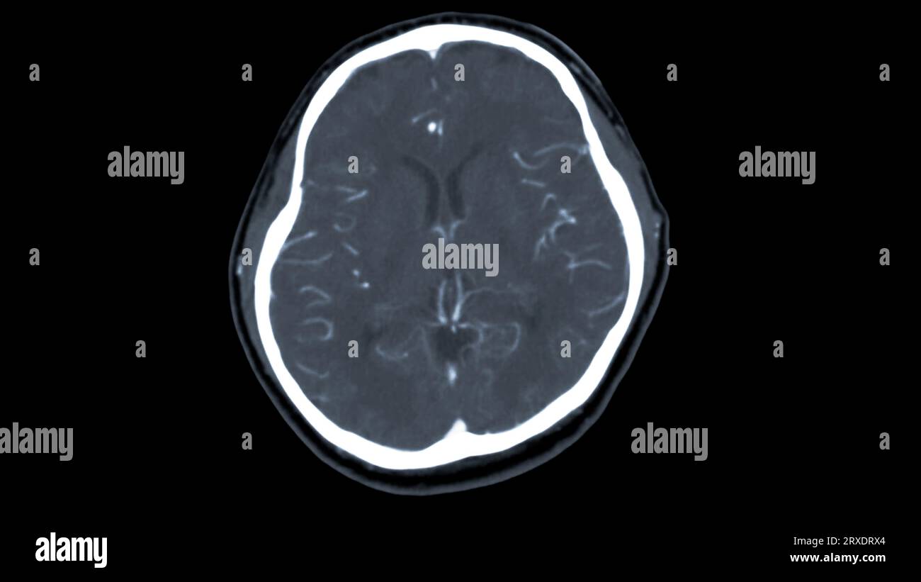 CT-Scan des Gehirns mit Injektionskontrastmittel zur Diagnose von Hirntumor, Schlaganfallerkrankungen und Gefässerkrankungen. Stockfoto