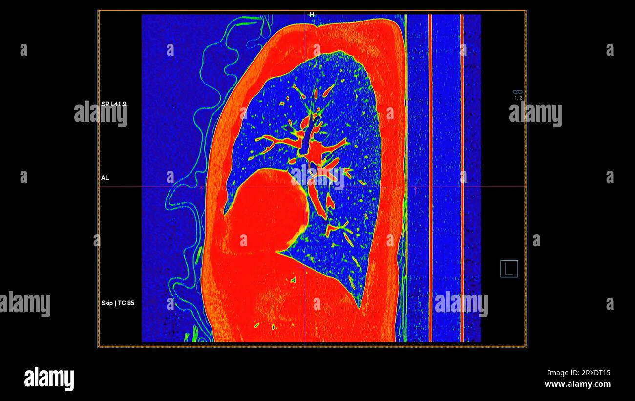 CT-Scan der koronalen Thoraxansicht im Farbmodus für diagnostische Lungenembolie (PE), Lungenkrebs und covid-19. Stockfoto