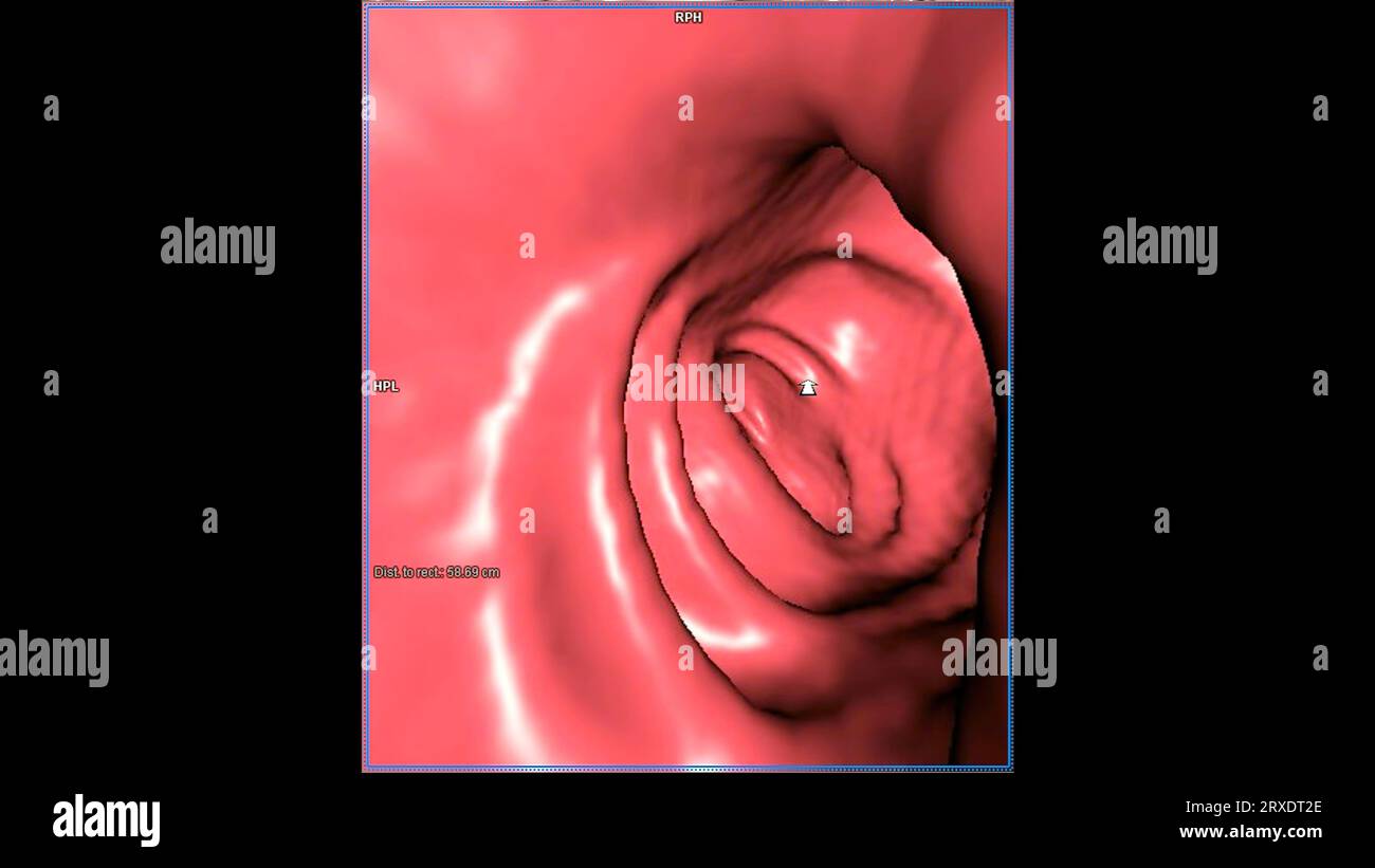 CT-Kolonographie-3D-Rendering-Bild für jährliche Gesundheitschecks zum Screening auf Darmkrebs. Stockfoto