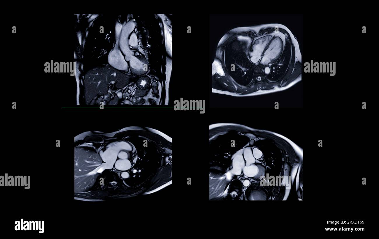 MRT Herz oder Herz-MRT ( Magnetresonanztomographie ) des Herzens zur Erkennung von Herzerkrankungen. Stockfoto