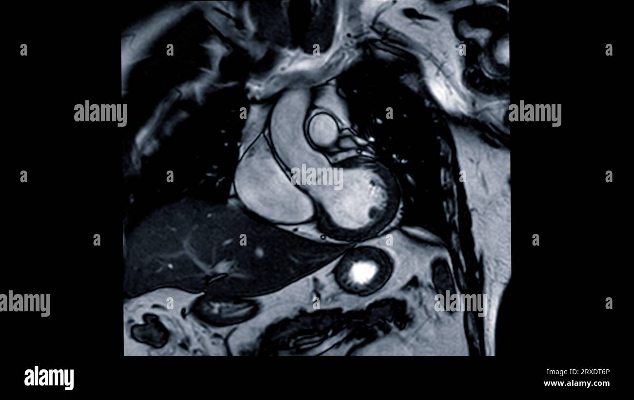 MRT-Herz- oder Herz-MRT ( Magnetresonanztomographie ) des Herzens in koronaler Ansicht mit Herzschlag zur Erkennung von Herzerkrankungen. Stockfoto