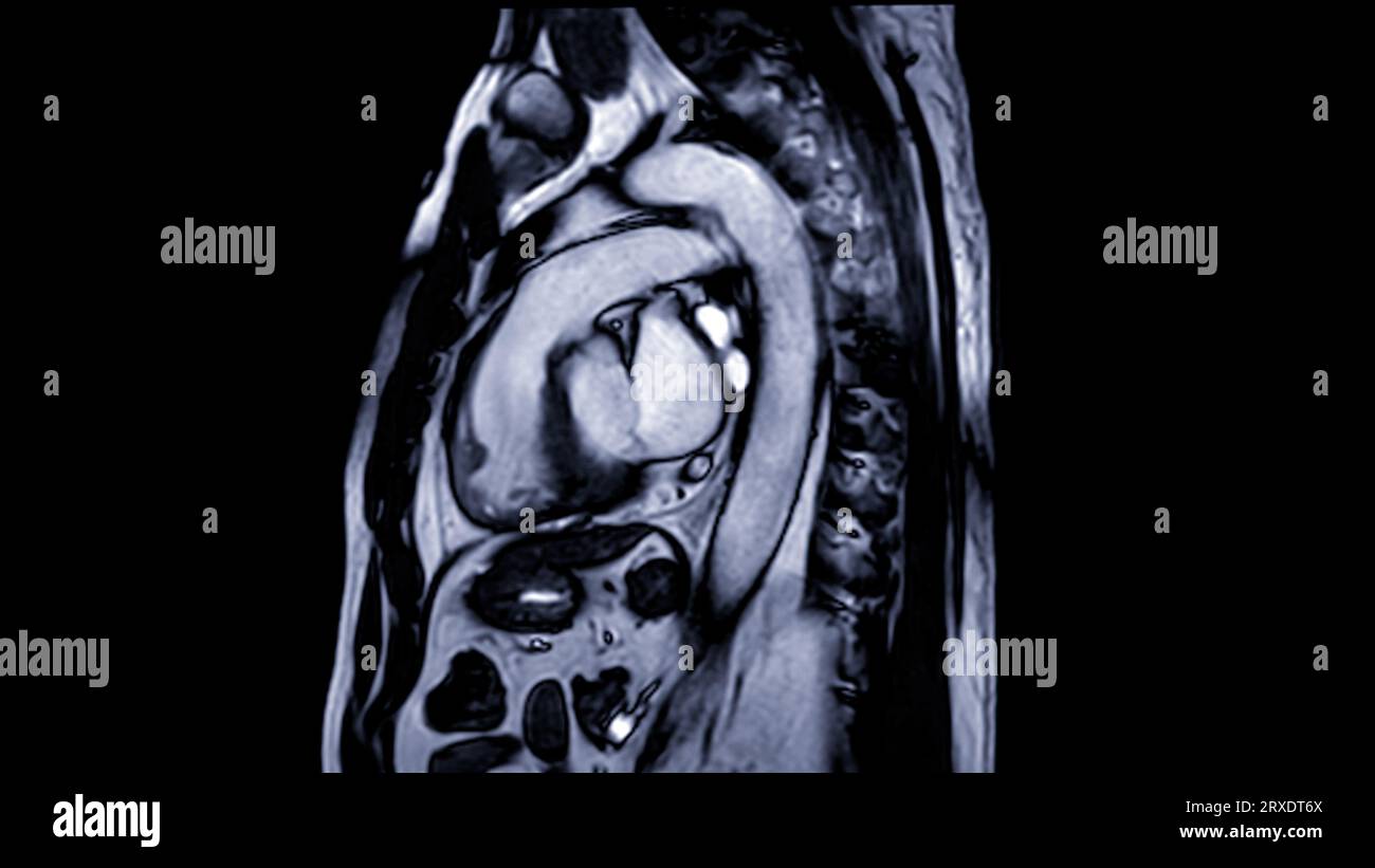 MRT Herz oder Herz-MRT ( Magnetresonanztomographie ) des Herzens zur Erkennung von Herzerkrankungen. Stockfoto