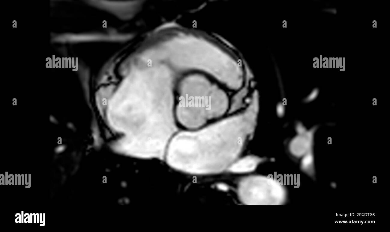 Kernspintomographie (MRT) des Herzens mit Aortenklappe. Stockfoto