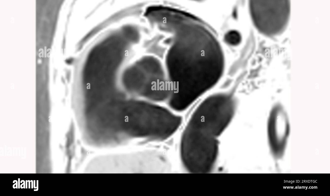 Kernspintomographie (MRT) des Herzens mit Aortenklappe. Stockfoto