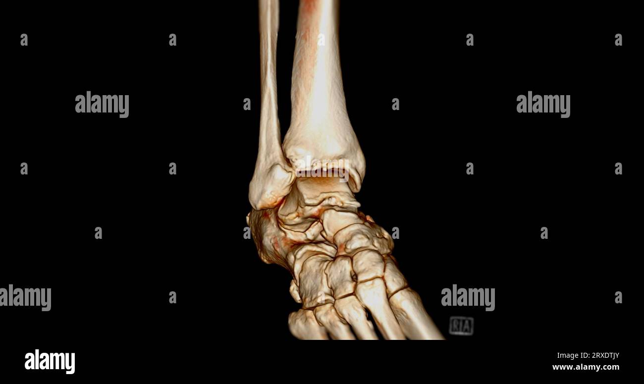 CT-Sprunggelenk-Scan oder Computertomographie des 3D-Rendering-Bildes des Sprunggelenks. Stockfoto
