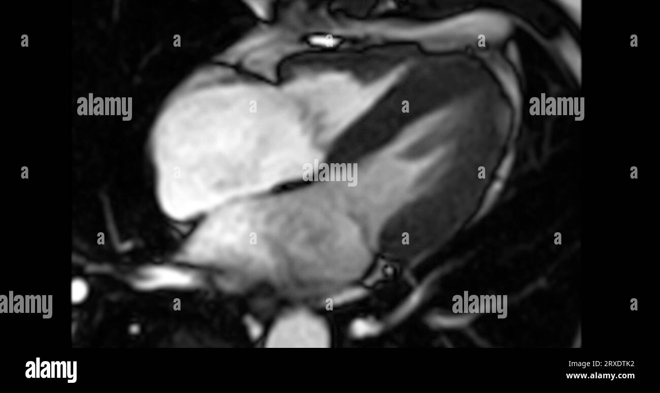 MRT Herz oder Herz MRT ( Magnetresonanztomographie ) des Herzens in Kurzachsenansicht mit Herzschlag von 4 Kammern zur Erkennung von Herzerkrankungen. Stockfoto