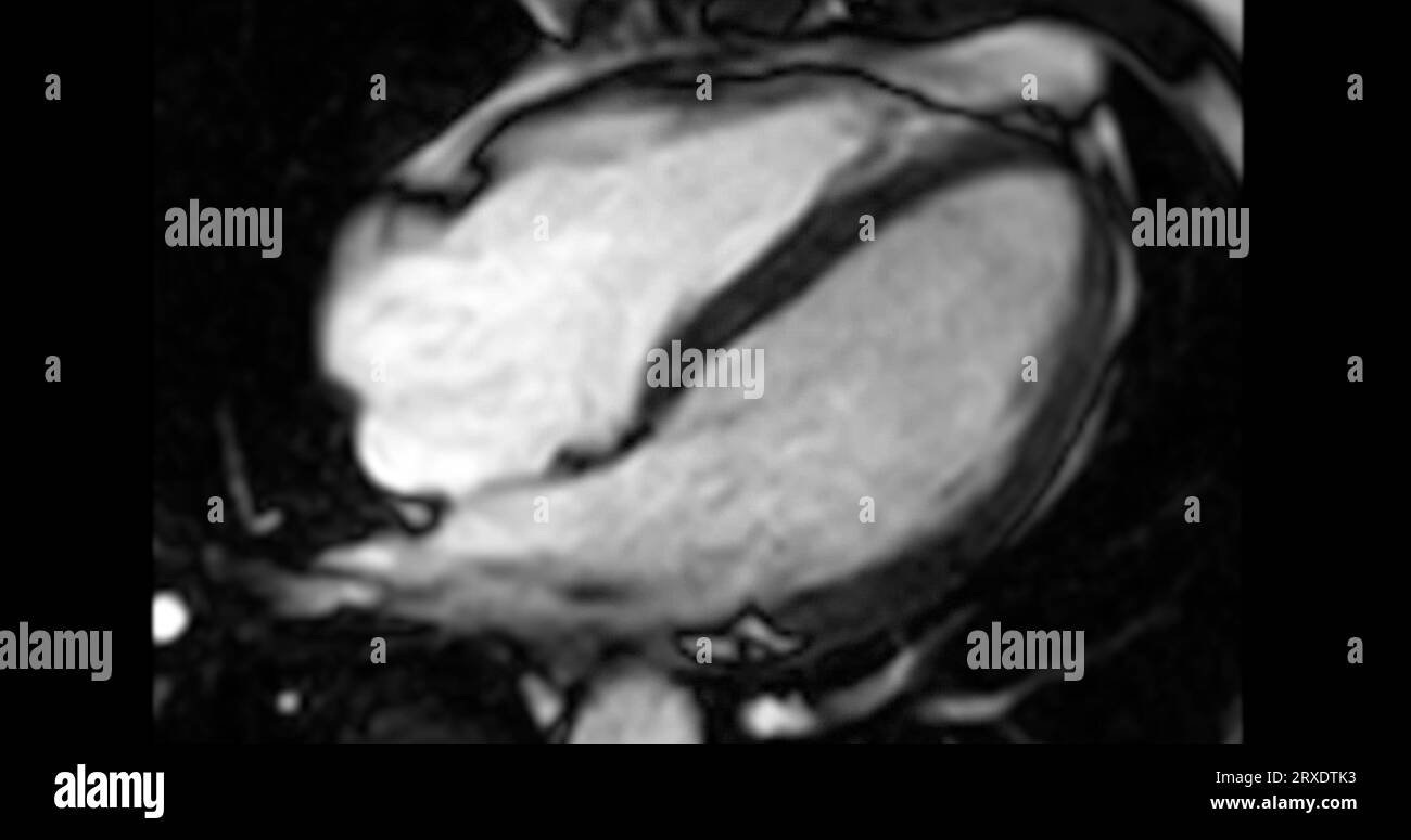 MRT Herz oder Herz MRT ( Magnetresonanztomographie ) des Herzens in Kurzachsenansicht mit Herzschlag von 4 Kammern zur Erkennung von Herzerkrankungen. Stockfoto