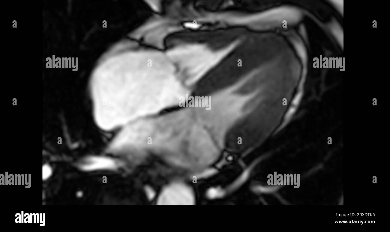 MRT Herz oder Herz MRT ( Magnetresonanztomographie ) des Herzens in Kurzachsenansicht mit Herzschlag von 4 Kammern zur Erkennung von Herzerkrankungen. Stockfoto