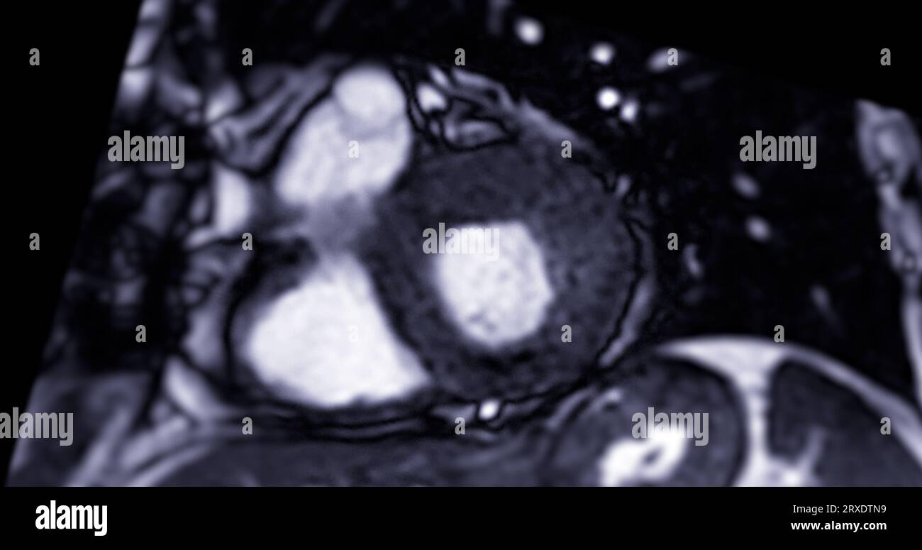 MRT-Herz- oder Herz-MRT ( Magnetresonanztomographie ) des Herzens in Kurzachsenansicht mit Herzschlag von 2 Kammern zur Erkennung von Herzerkrankungen. Stockfoto