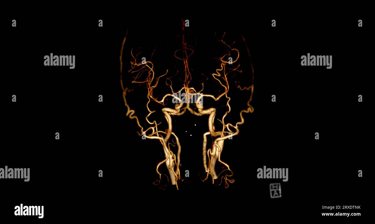 CTA-HIRN- oder CT-Angiographie des Gehirns 3D-Rendering-Bild AP und laterale Ansicht mit Darstellung der Hirnarterie. Stockfoto