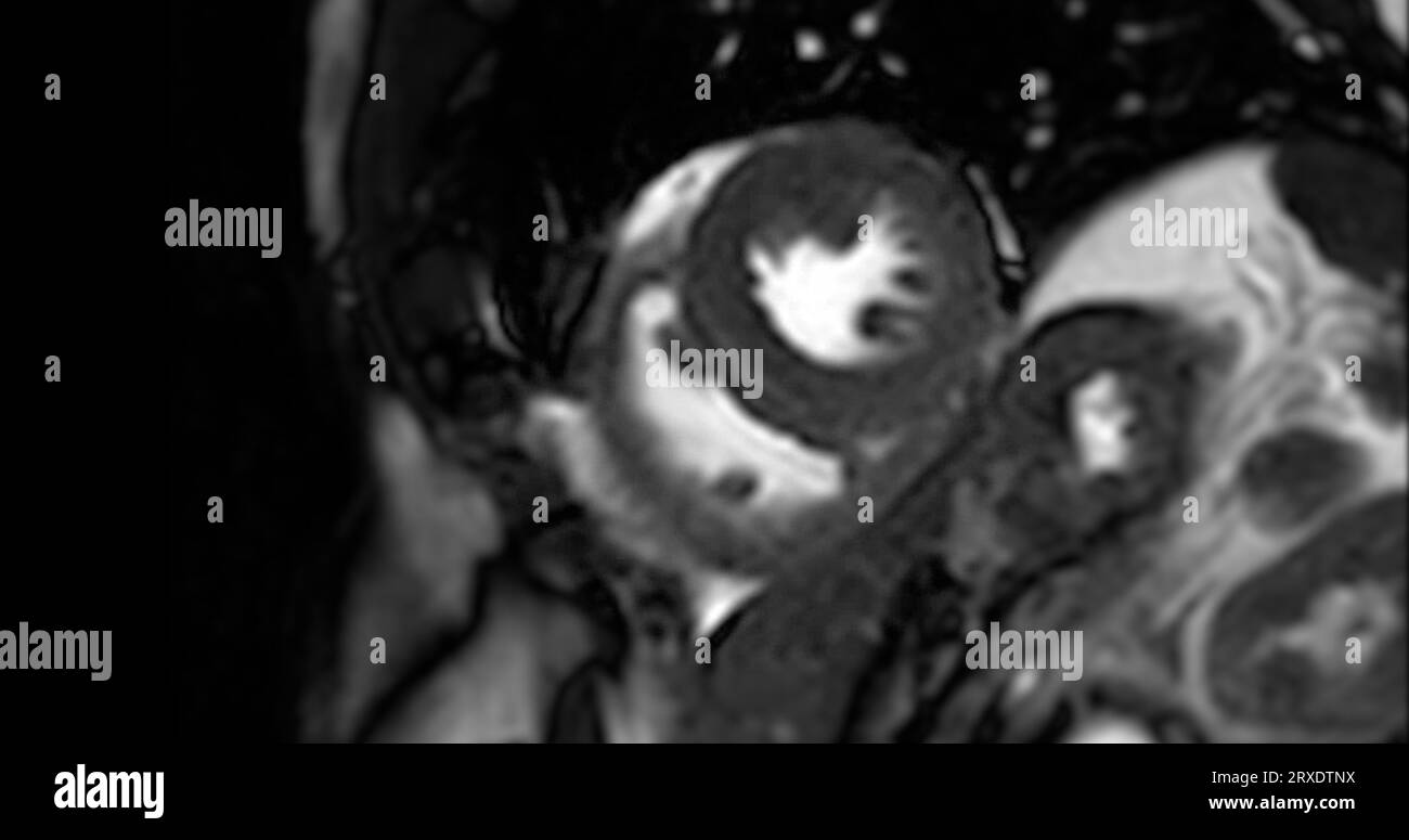 MRT-Herz- oder Herz-MRT ( Magnetresonanztomographie ) des Herzens in Kurzachsenansicht mit Herzschlag von 2 Kammern zur Erkennung von Herzerkrankungen. Stockfoto