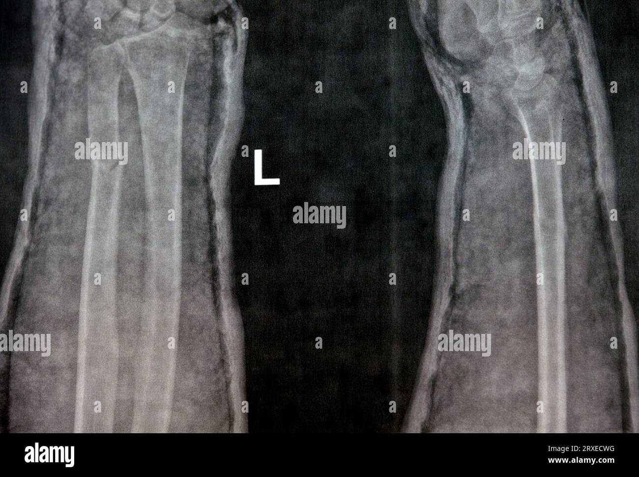 Ein Röntgenbild des rechten Unterarms (irrtümlich links auf dem Film geschrieben) zeigt eine Fraktur des unteren Teils der Ulna in der Besetzung für 4 Wochen und beginnt zu heilen Stockfoto