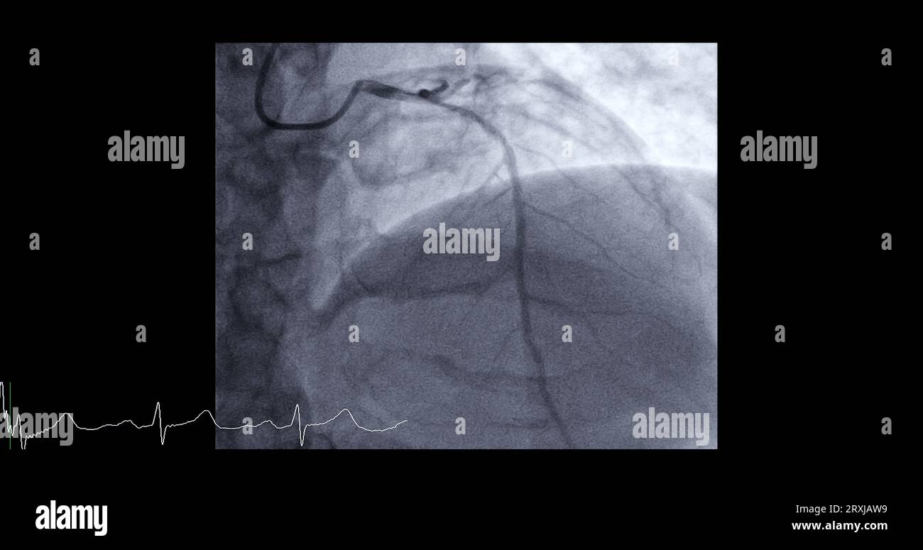 Herzkatheterisierung an der linken anterioren absteigenden Arterie (LAD) kann dem Arzt bei der Diagnose und Behandlung von Problemen in Ihrem Herz und Blutgefäßen wie helfen Stockfoto