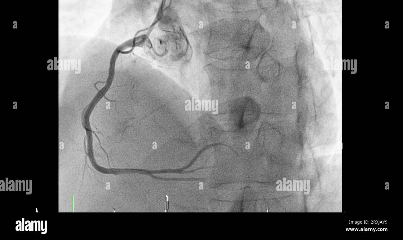 Herzkatheterisierung an der rechten Koronararterie (RCA) kann dem Arzt helfen, Probleme in Ihrem Herz und Ihren Blutgefäßen, wie z. B. ein Herz bei, zu diagnostizieren und zu behandeln Stockfoto