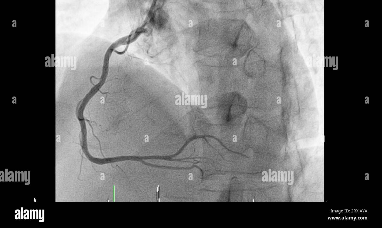 Herzkatheterisierung an der rechten Koronararterie (RCA) kann dem Arzt helfen, Probleme in Ihrem Herz und Ihren Blutgefäßen, wie z. B. ein Herz bei, zu diagnostizieren und zu behandeln Stockfoto