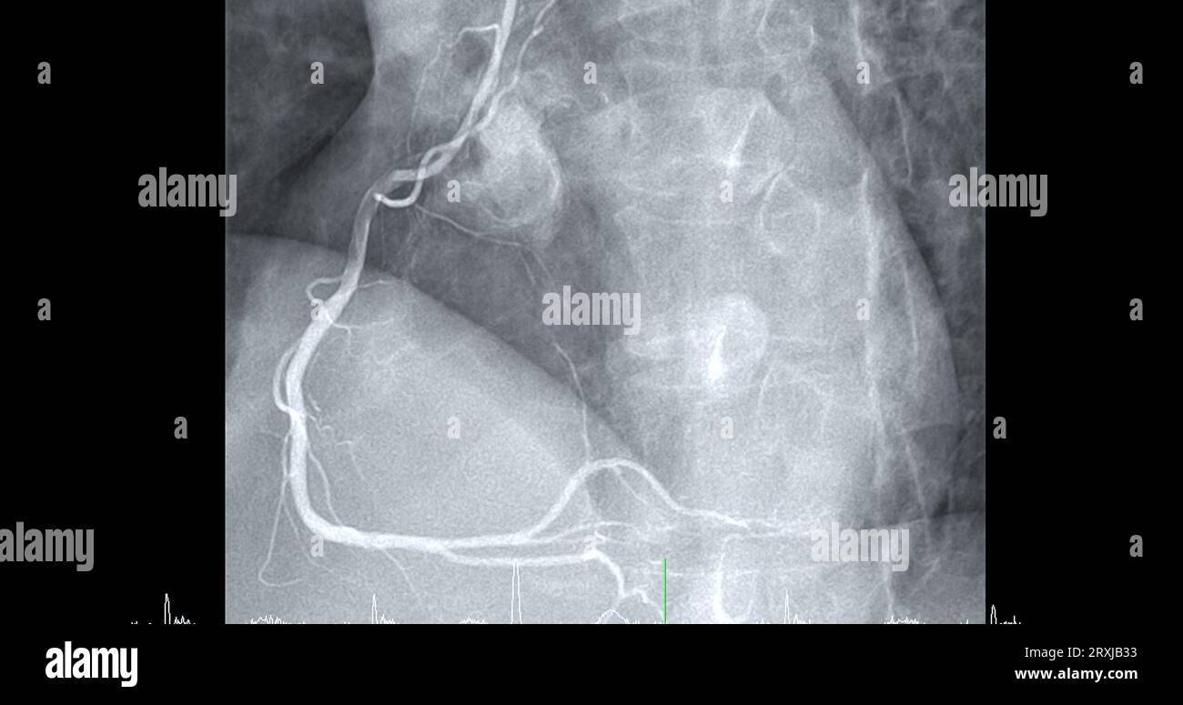 Herzkatheterisierung an der rechten Koronararterie (RCA) kann dem Arzt helfen, Probleme in Ihrem Herz und Ihren Blutgefäßen, wie z. B. ein Herz bei, zu diagnostizieren und zu behandeln Stockfoto