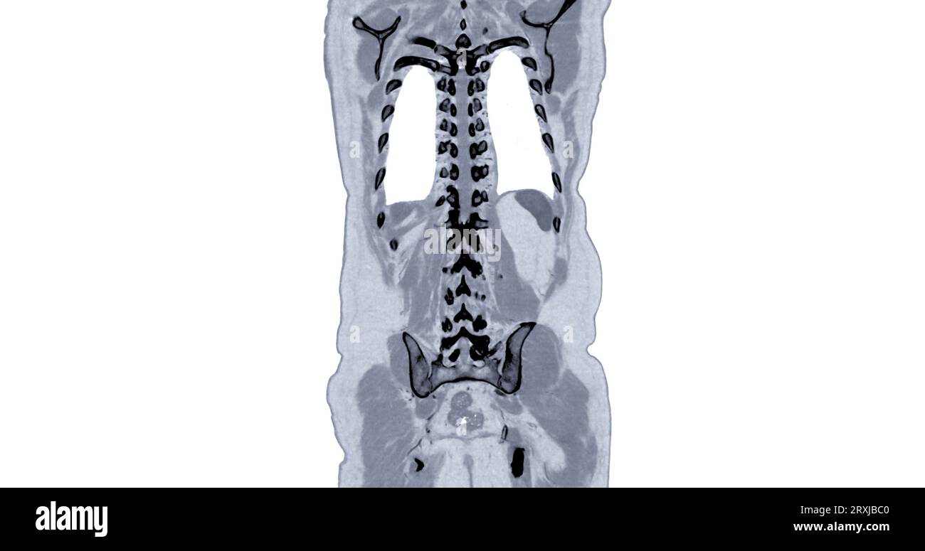 CT Brust und Abdomen mit koronaler Kontrastmittelinjektion zur Diagnose von Brust- und Abdominalschmerzen. Stockfoto