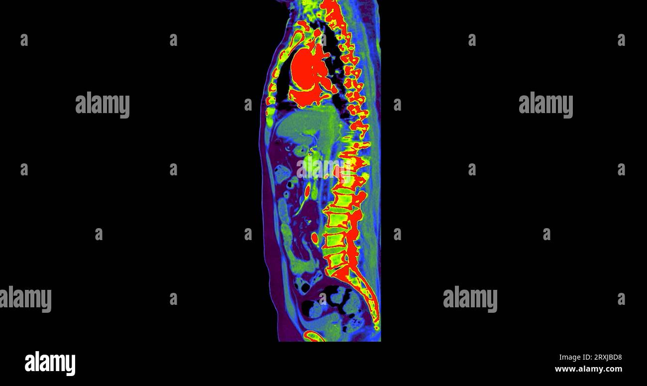 CT Brust und Abdomen mit Injektionskontrastmittel sagittale Ebene zur Diagnose von Brust- und Abdominalschmerzen. Stockfoto
