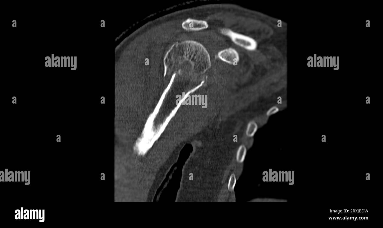 CT-Scan des Schultergelenks bei fallender Schultergelenkfraktur. Stockfoto