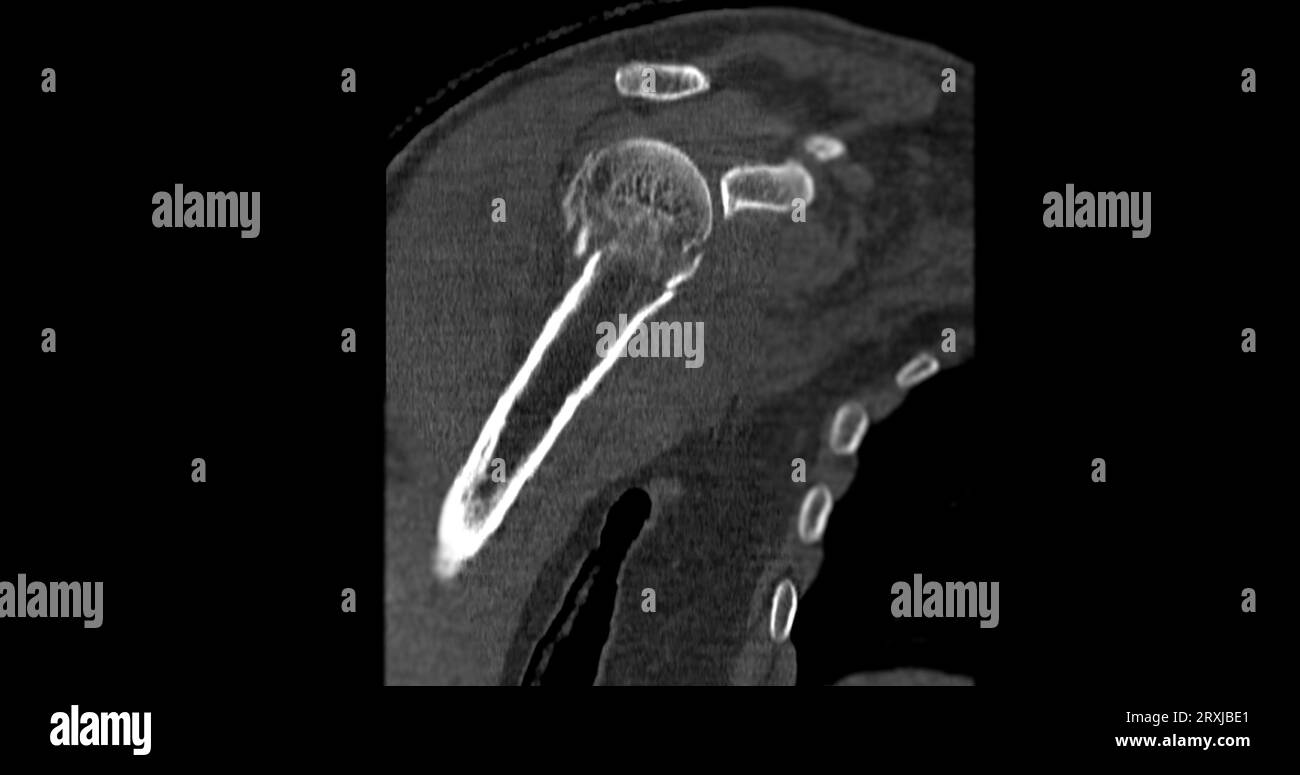 CT-Scan des Schultergelenks bei fallender Schultergelenkfraktur. Stockfoto
