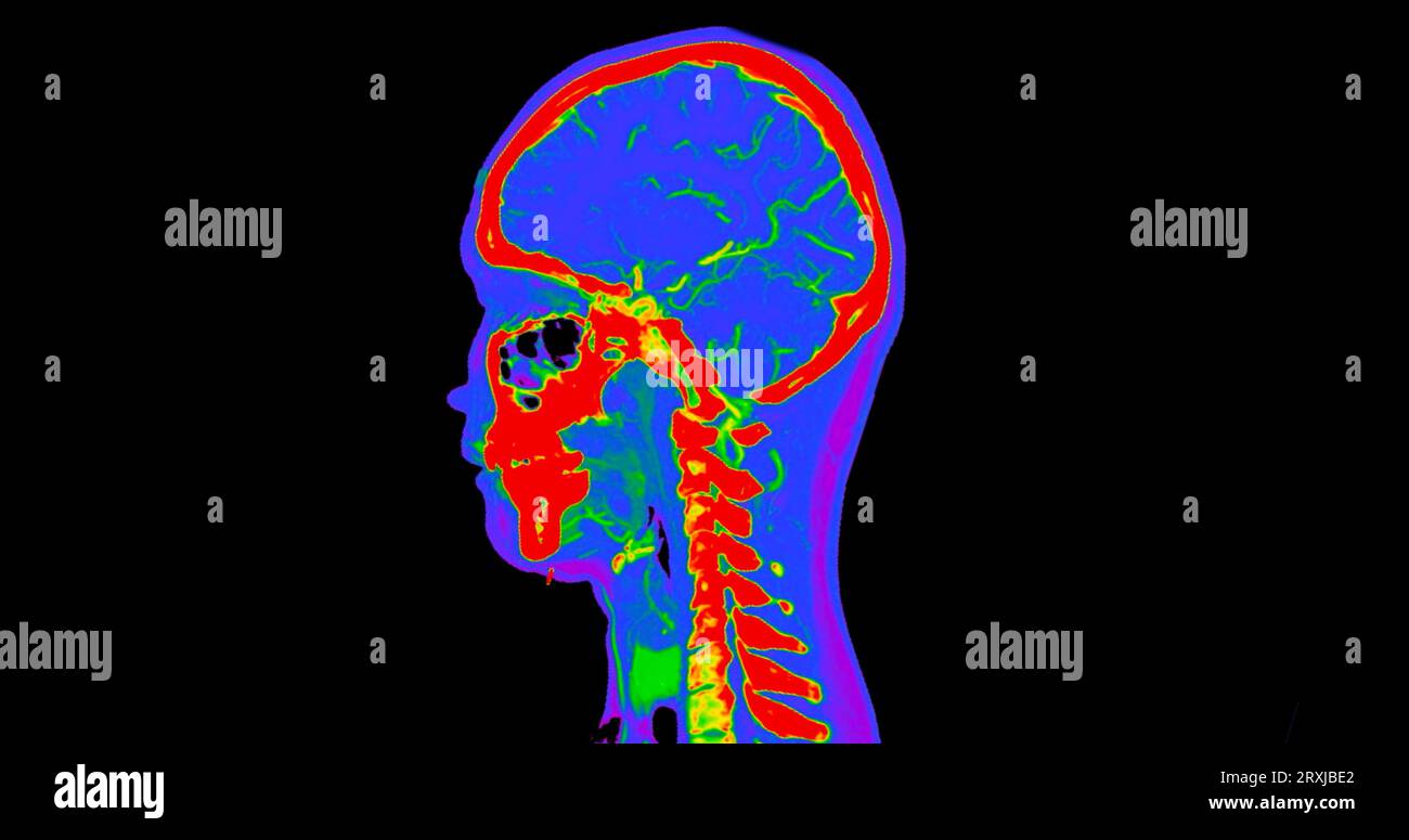 CT-Angiographie des Gehirns oder CTA Gehirn und Hals Sagittal-Ansicht 3D-Rendering-Bildfusion Farbmodus. Medizintechnisches Konzept. Stockfoto