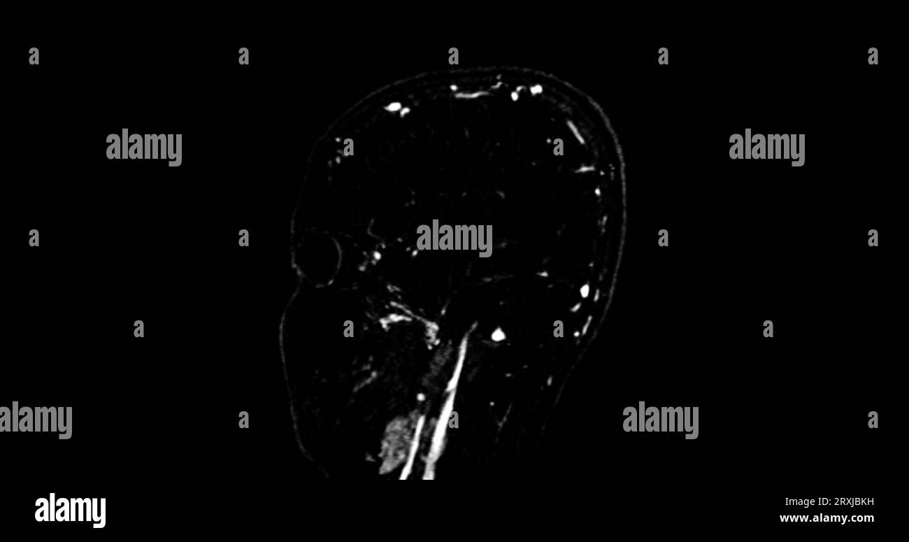 MRV-Hirn- oder Magnetresonanzvenographie des Gehirns zur Diagnostik von Anomalien bei venöser Drainage des Gehirns Stockfoto