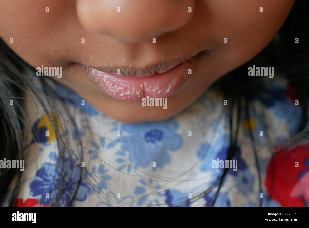 Nahaufnahme der trockenen Lippe eines Kindes Stockfoto
