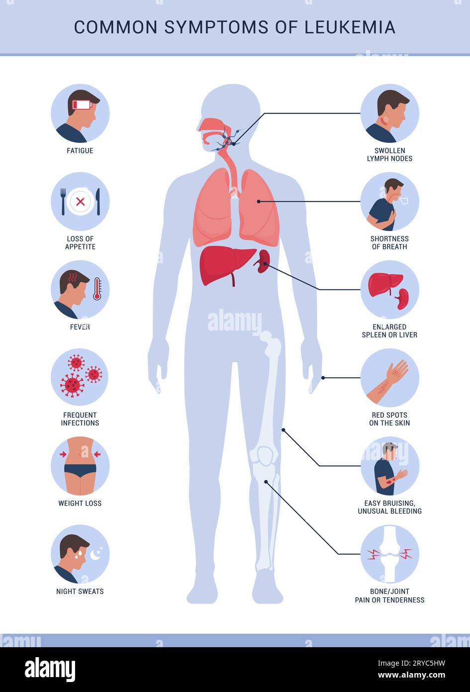 Häufige Symptome und Anzeichen von Leukämie, Infografik mit Symbolen Stock Vektor