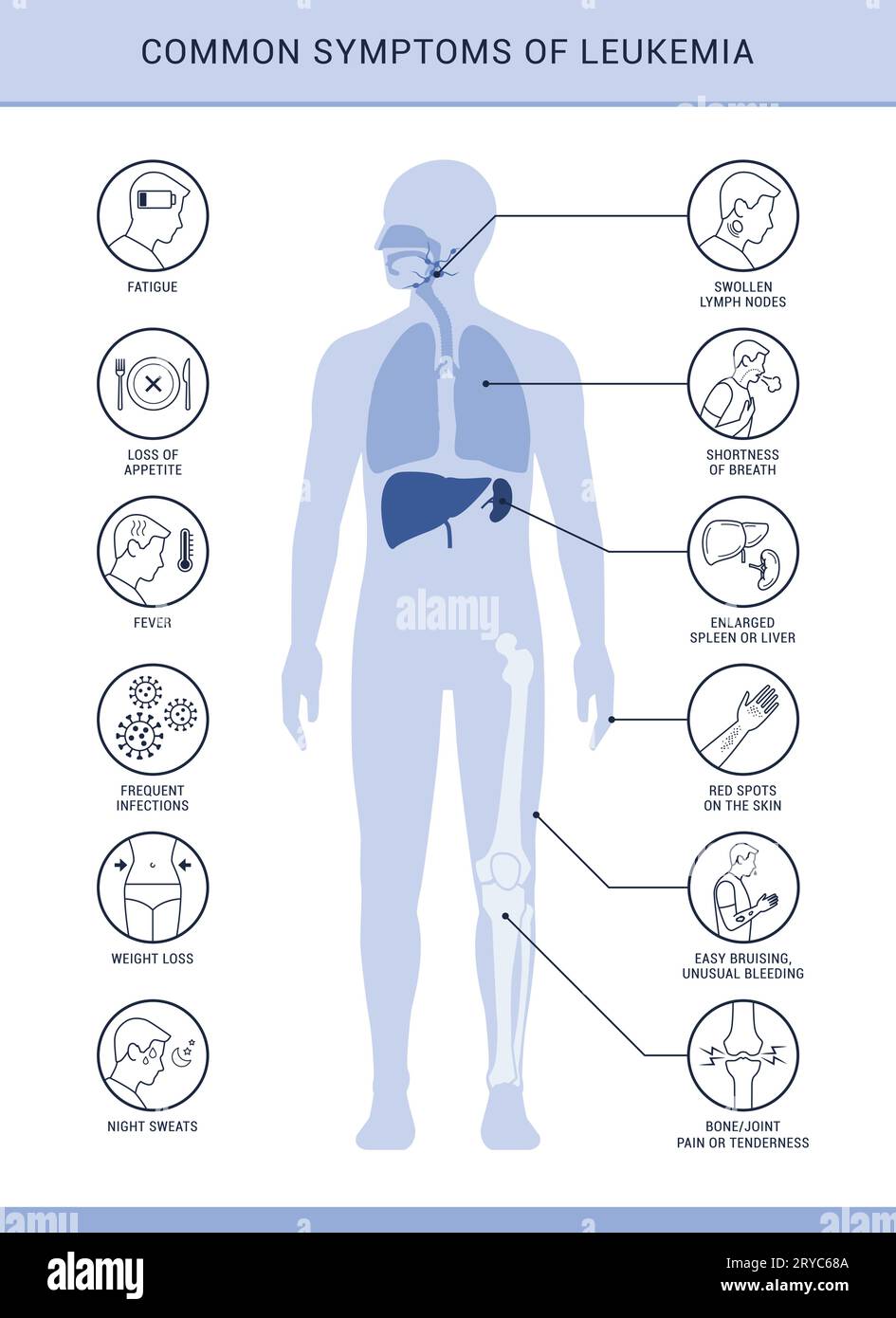Häufige Symptome und Anzeichen von Leukämie, Infografik mit Symbolen Stock Vektor