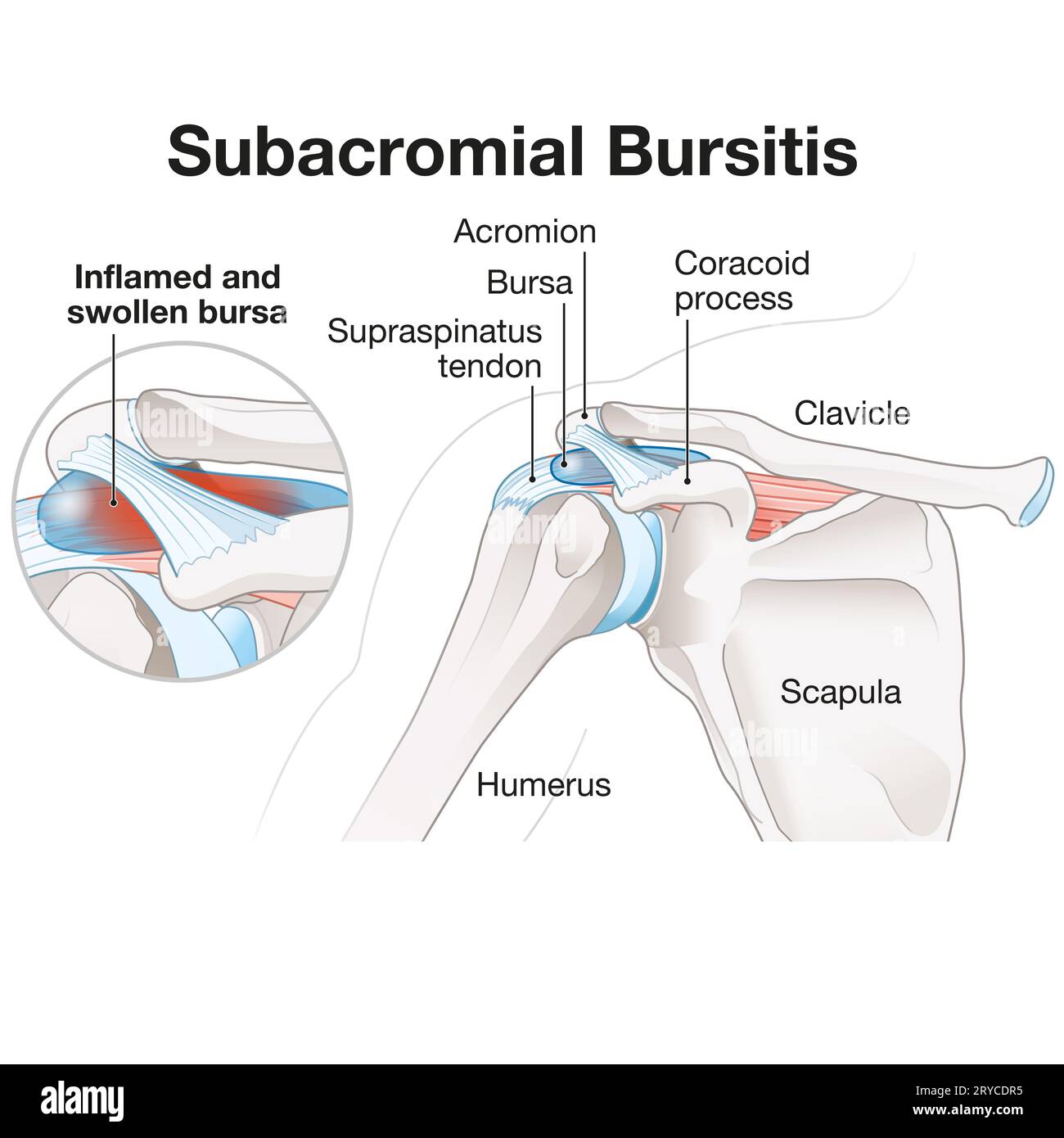 Eine Bursitis subacromialis ist eine Entzündung der Bursa in der Schulter, die Schmerzen, Schwellungen und eine eingeschränkte Mobilität verursacht und häufig mit Rotatorenmanschette in Verbindung gebracht wird Stockfoto
