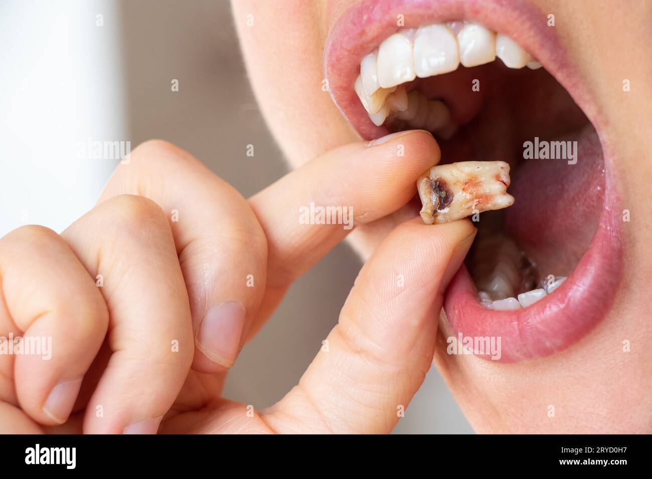 Ein Mädchen in der Hand hält einen ausgezogenen Zahn mit einem schwarzen Loch in der Mitte des Zahns nah an, einen kranken Zahn in der Hand nach der Entfernung, der n könnte Stockfoto