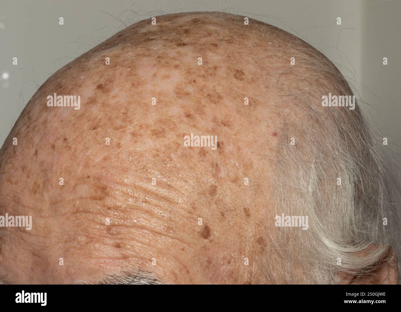 Detaillierte Nahaufnahme des Kopfes einer älteren Person mit Schwerpunkt auf dem dünneren grauen Haar, der faltigen Kopfhaut und verschiedenen Hautflecken, die das natura hervorheben Stockfoto