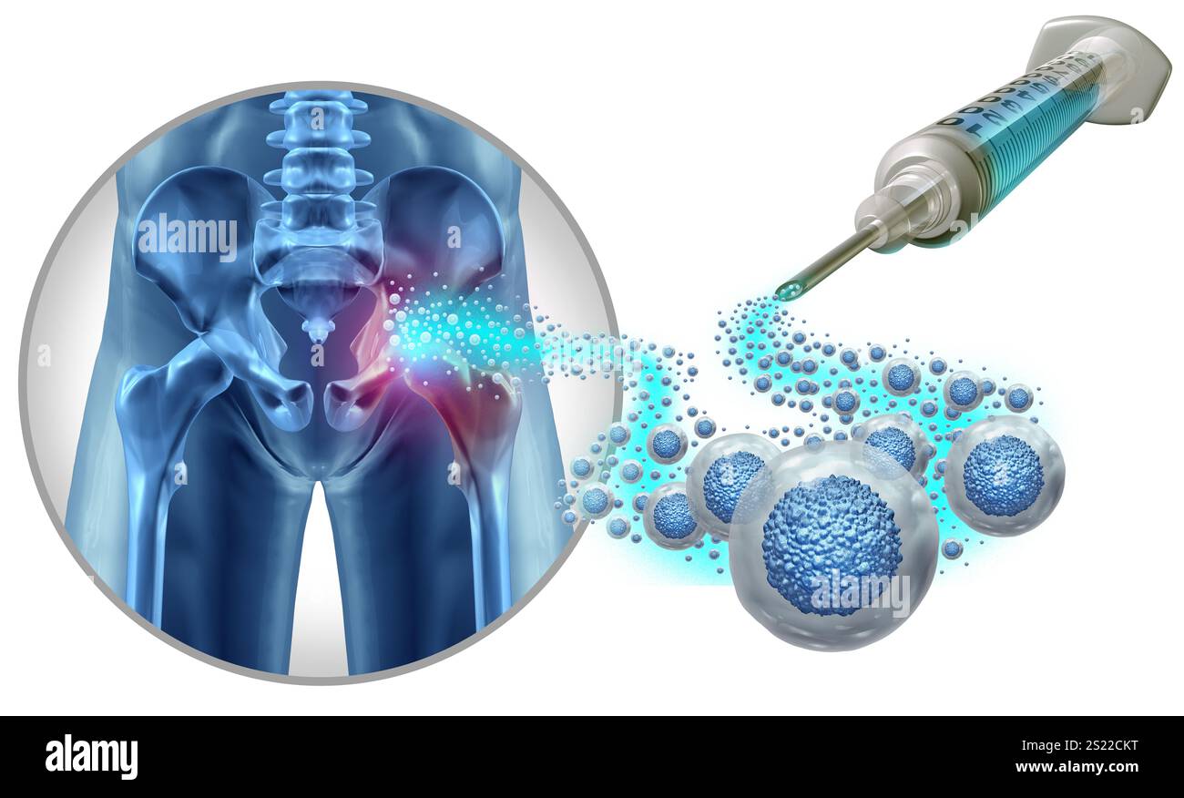 Hüftstammzelltherapie und koxalgelenkregenerative Therapien oder Hüftbehandlung als restaurative Medizin und mesenchymale Stammzellen zur Schmerztherapie Stockfoto