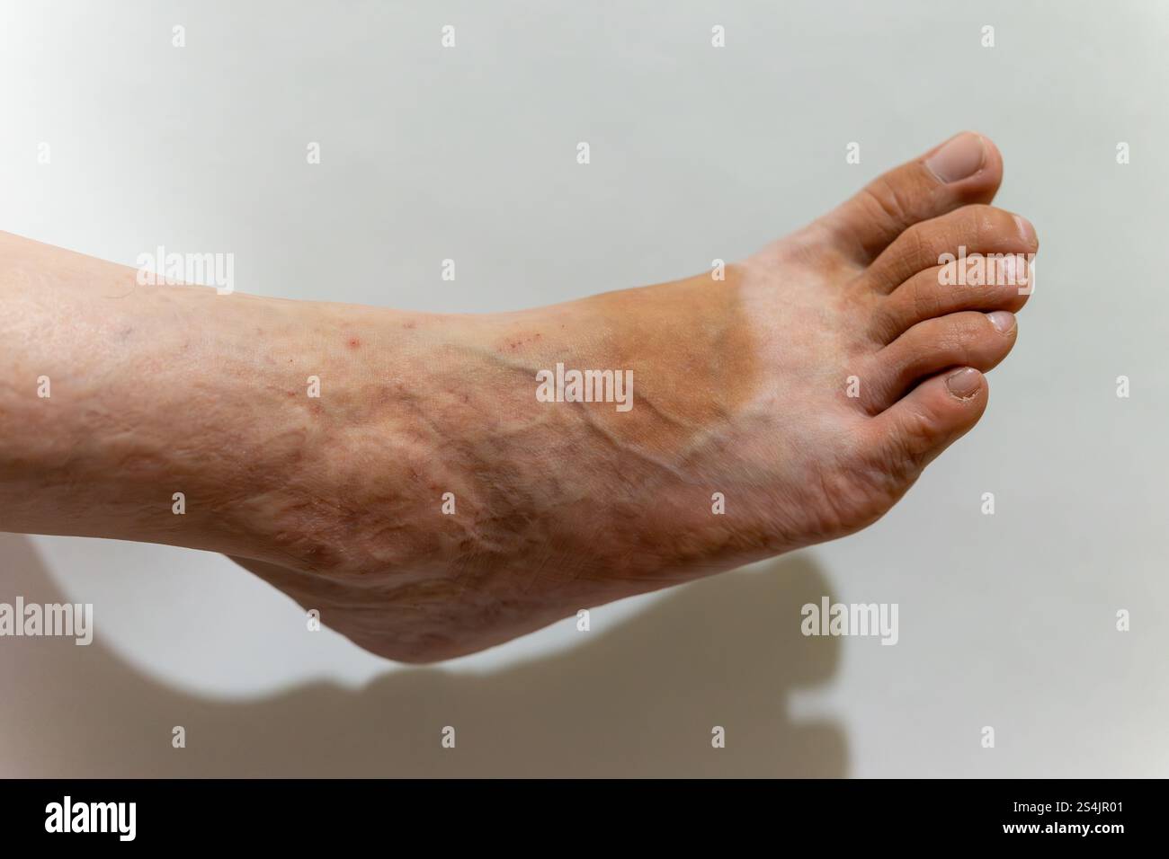 Nahaufnahme eines Fußes mit ausgeprägten Venen und ungleichmäßigem Hautton. Der Fuß liegt vor einem soliden Hintergrund, der von sanften, natürlichen Lampen beleuchtet wird Stockfoto