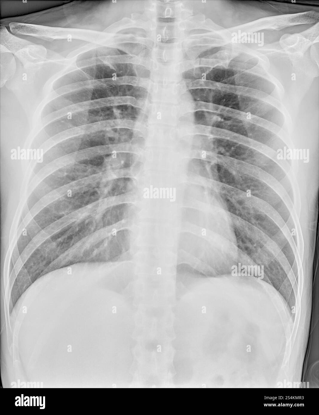 Normalradiographie der Brustorgane bei direkter Projektion, Pulmonologie Stockfoto